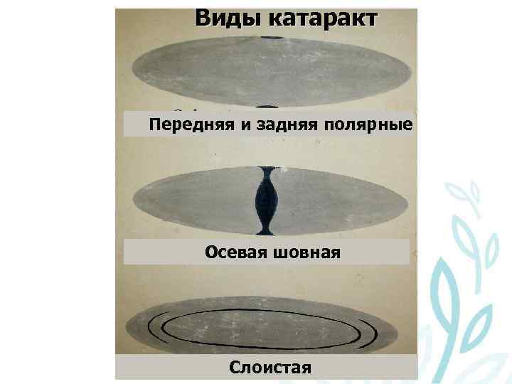 Виды катаракт Передняя и задняя полярные Осевая шовная Слоистая 
