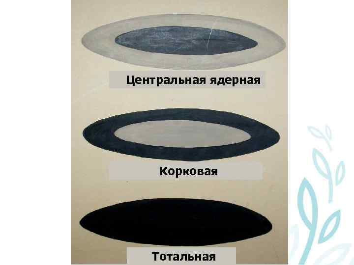 Центральная ядерная Корковая Тотальная 