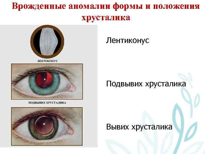 Врожденные аномалии формы и положения хрусталика Лентиконус Подвывих хрусталика Вывих хрусталика 