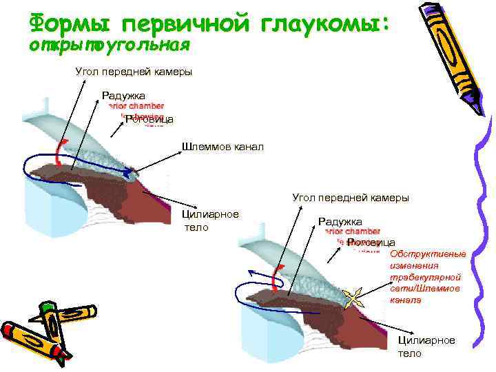 Формы первичной глаукомы: открытоугольная Угол передней камеры Радужка Роговица Шлеммов канал Угол передней камеры