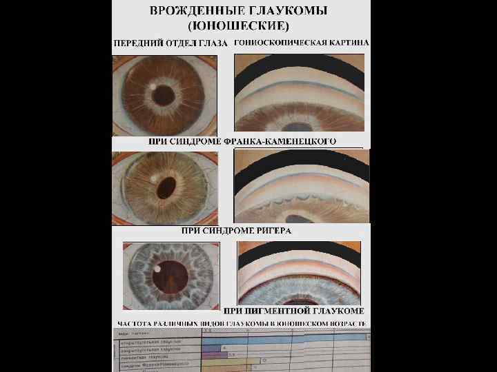 Классификация глаукомы
