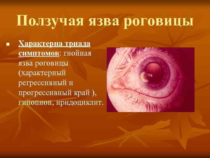Ползучая язва роговицы n Характерна триада симптомов: гнойная язва роговицы (характерный регрессивный и прогрессивный