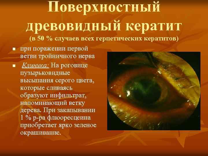 Поверхностный древовидный кератит n n (в 50 % случаев всех герпетических кератитов) при поражении