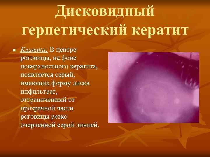 Дисковидный герпетический кератит n Клиника: В центре роговицы, на фоне поверхностного кератита, появляется серый,