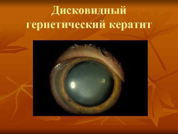 Дисковидный герпетический кератит 