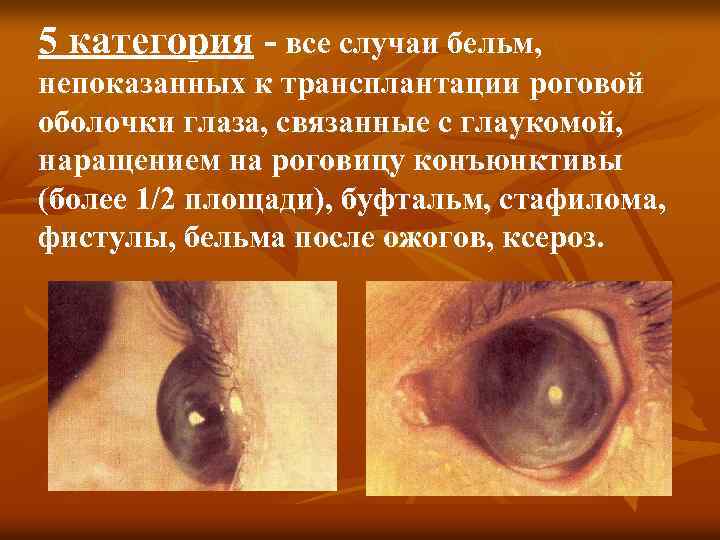 5 категория - все случаи бельм, непоказанных к трансплантации роговой оболочки глаза, связанные с