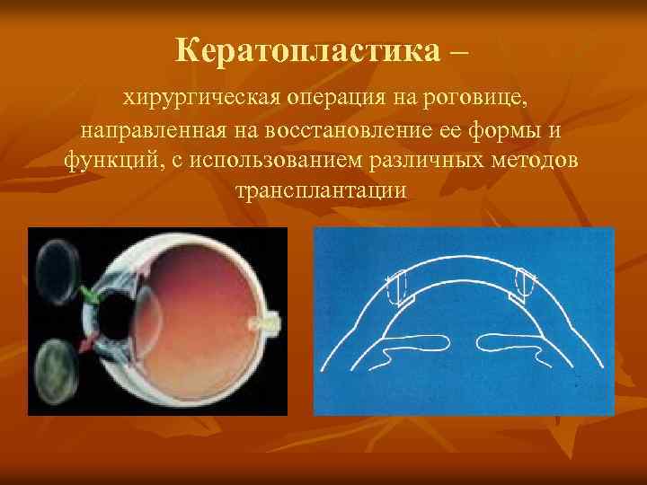 Кератопластика – хирургическая операция на роговице, направленная на восстановление ее формы и функций, с