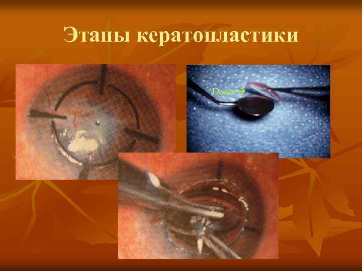 Этапы кератопластики 