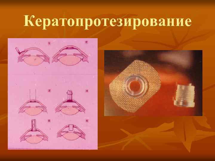 Кератопротезирование 