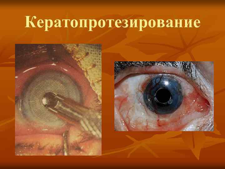 Кератопротезирование 