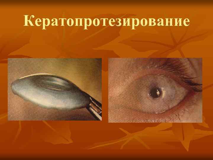 Кератопротезирование 