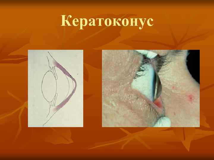 Кератоконус 