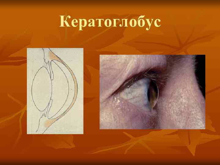 Кератоглобус 