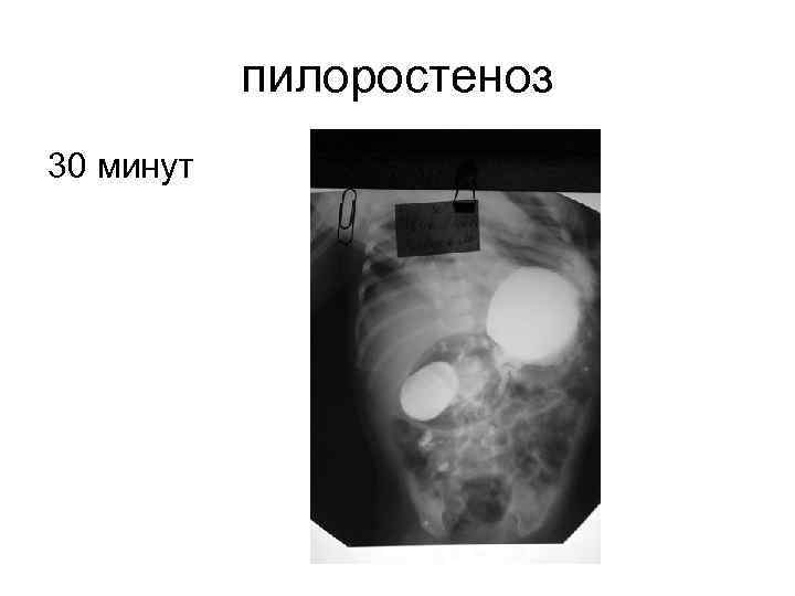 Пилоростеноз врожденный презентация