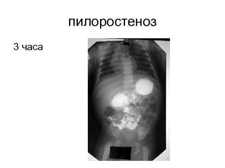 Пилоростеноз врожденный презентация