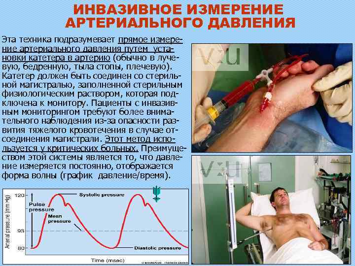 ИНВАЗИВНОЕ ИЗМЕРЕНИЕ АРТЕРИАЛЬНОГО ДАВЛЕНИЯ Эта техника подразумевает прямое измерение артериального давления путем установки катетера
