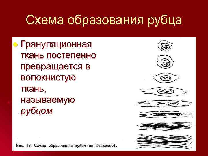 Схема образования рубца l Грануляционная ткань постепенно превращается в волокнистую ткань, называемую рубцом 