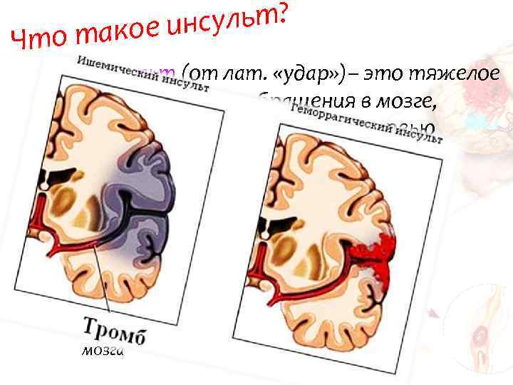 сульт? акое ин Что т • !!!Инсульт (от лат. «удар» )– это тяжелое нарушение