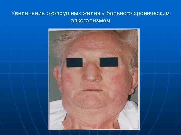 Увеличение околоушных желез у больного хроническим алкоголизмом 