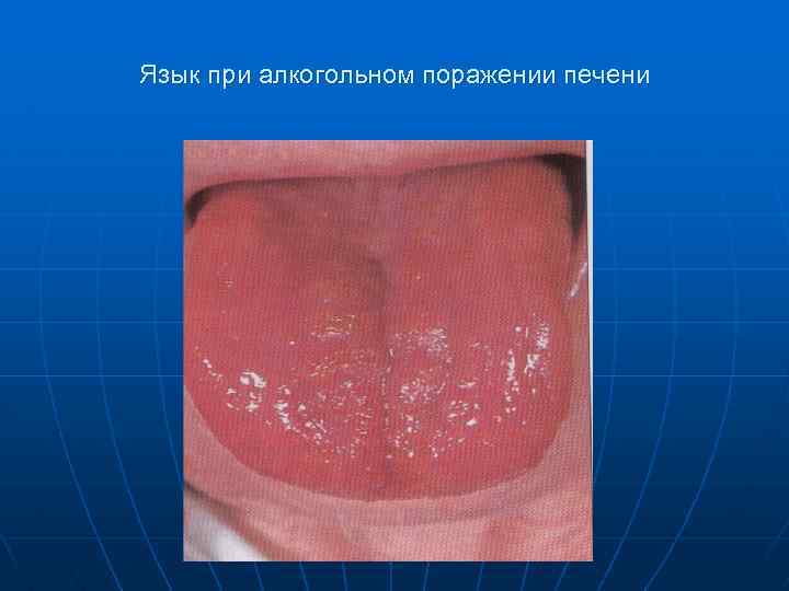 Язык при алкогольном поражении печени 