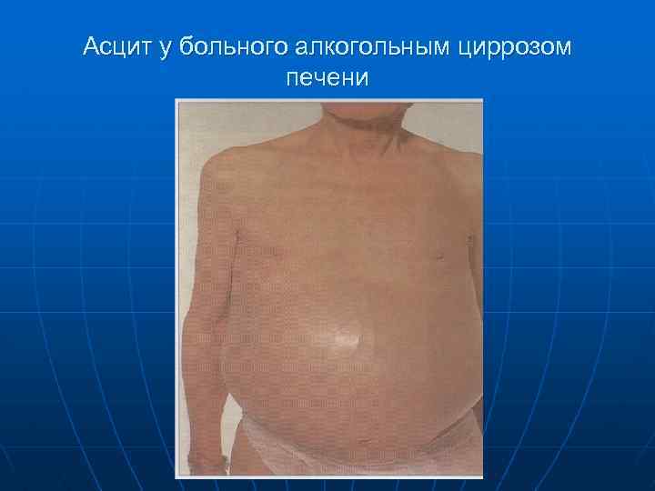 Асцит у больного алкогольным циррозом печени 