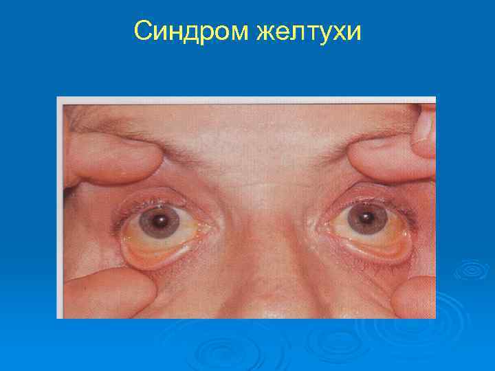 Синдром желтухи 
