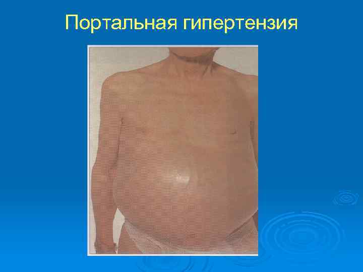 Портальная гипертензия 