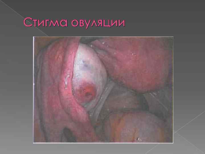 Стигма овуляции 