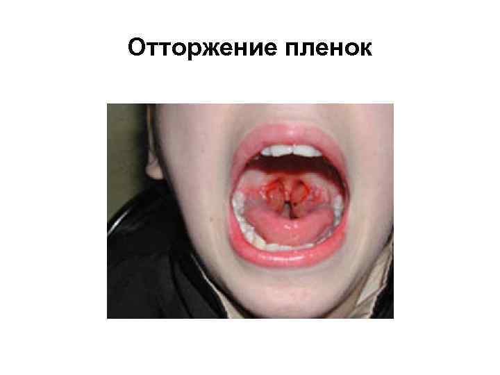 Отторжение пленок 