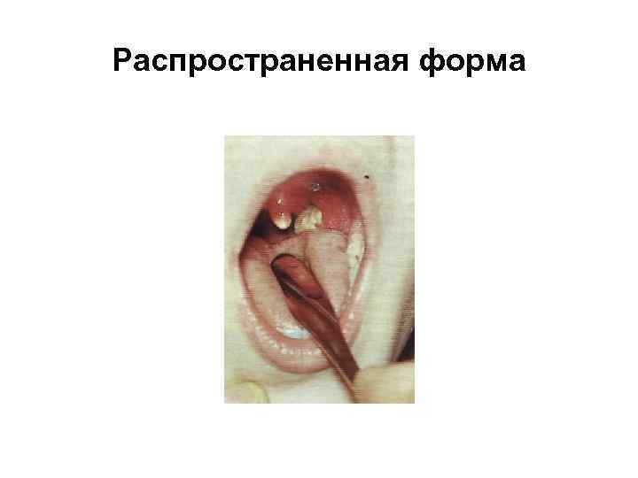 Распространенная форма 