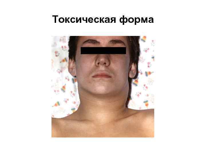 Токсическая форма 