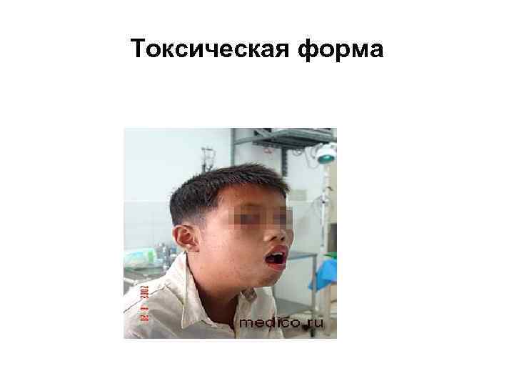 Токсическая форма 