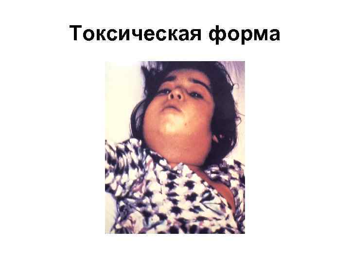 Токсическая форма 