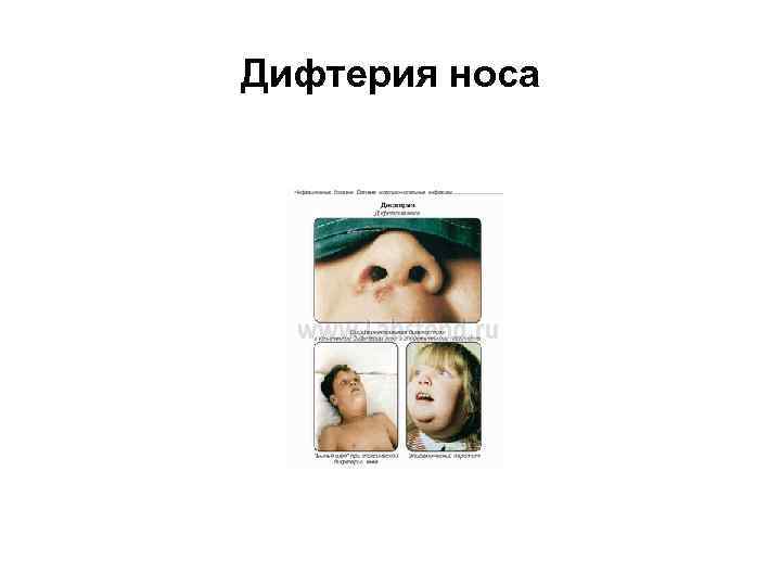 Дифтерия носа 