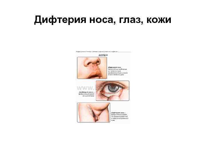 Дифтерия носа, глаз, кожи 
