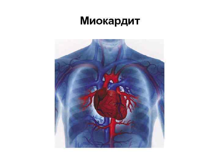 Миокардит 