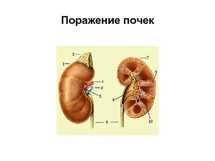 Поражение почек 