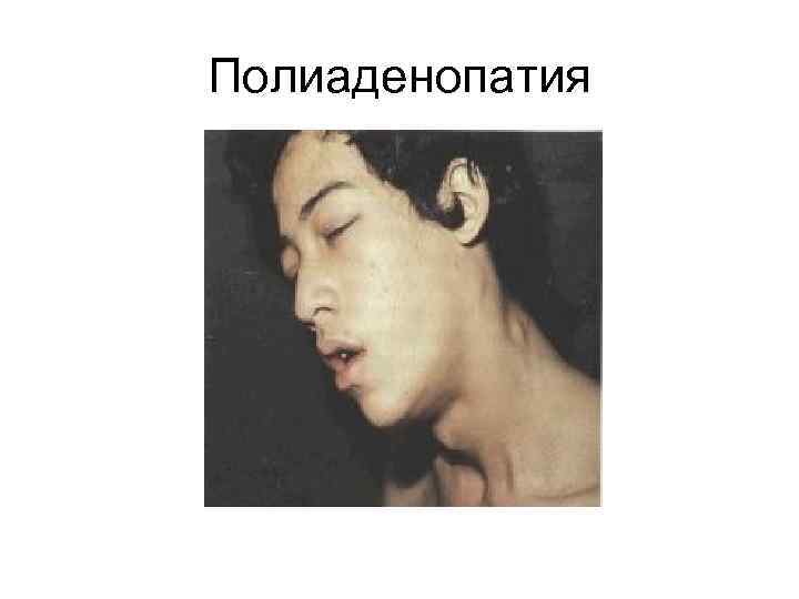 Полиаденопатия 