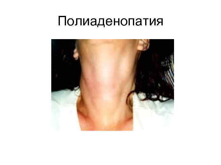 Полиаденопатия 