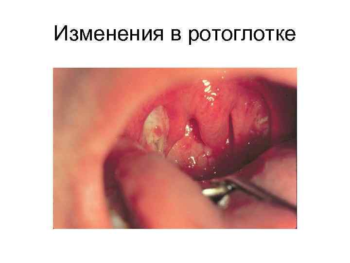 Изменения в ротоглотке 
