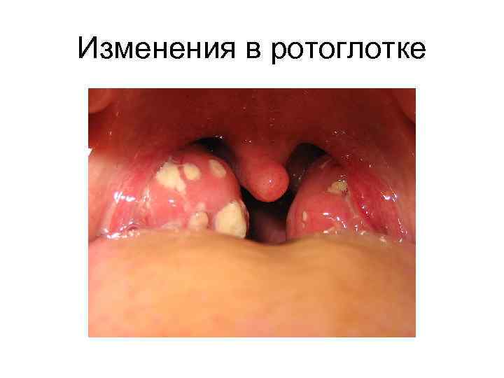 Изменения в ротоглотке 