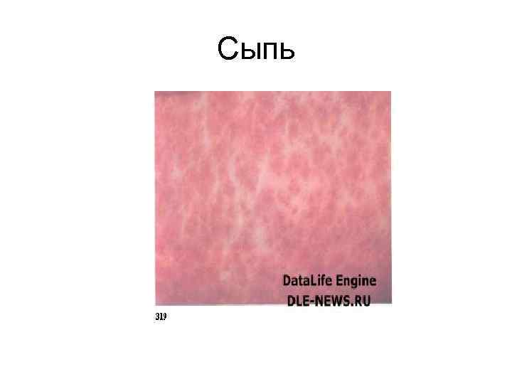 Сыпь 