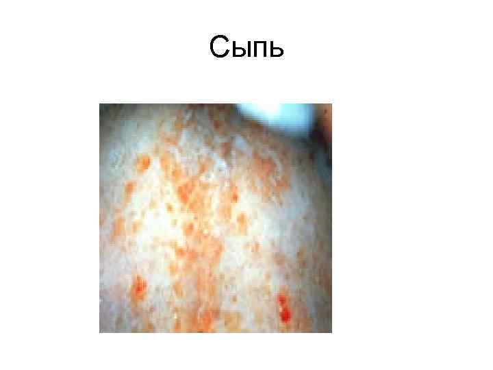 Сыпь 