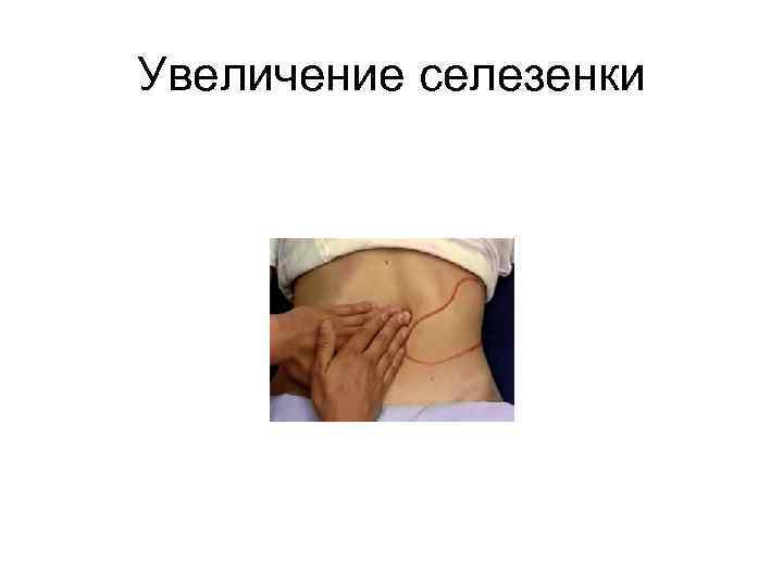 Увеличение селезенки 