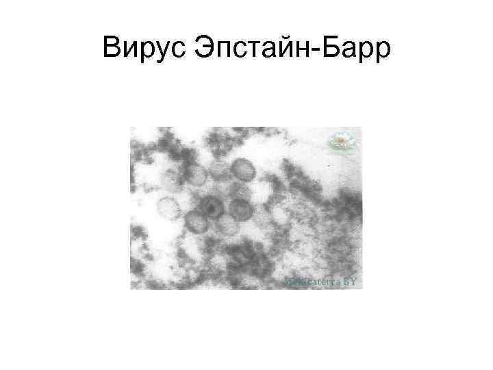 Вирус Эпстайн-Барр 