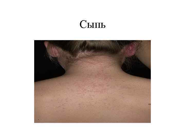 Сыпь 