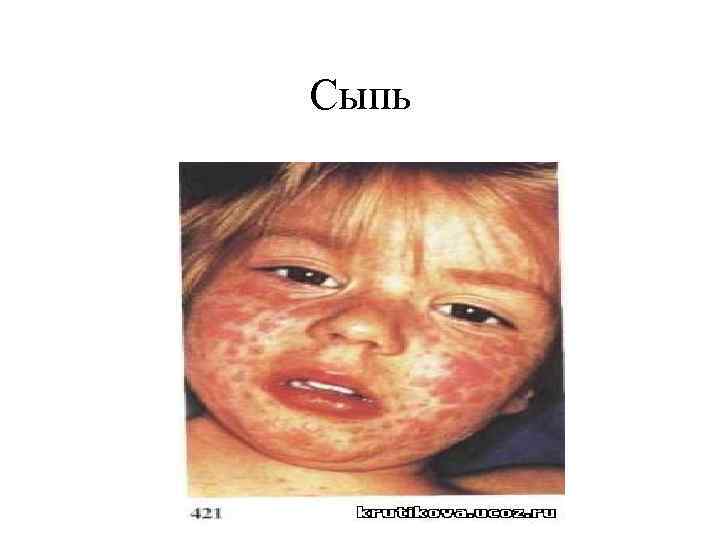 Сыпь 