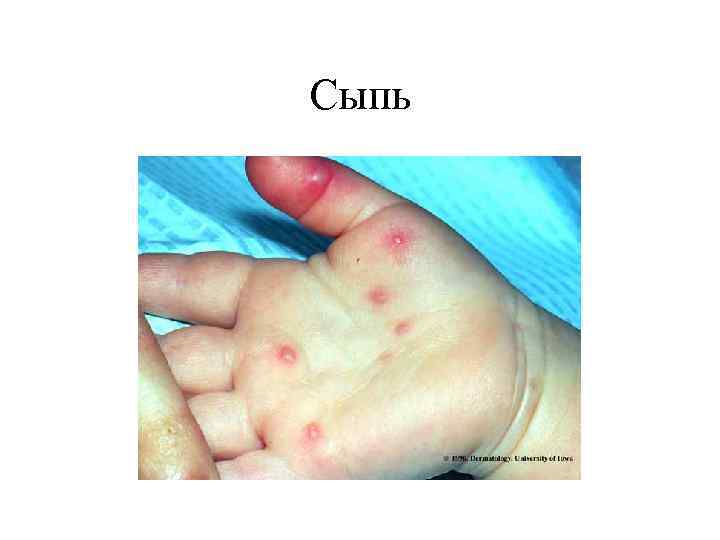 Сыпь 