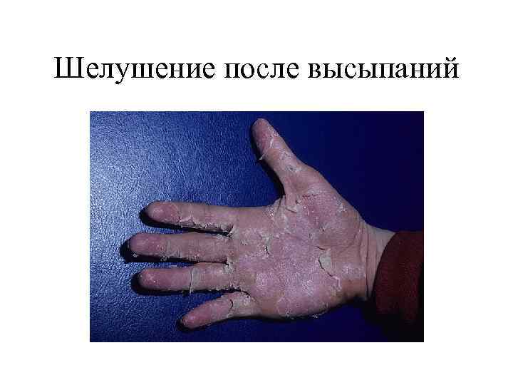 Шелушение после высыпаний 