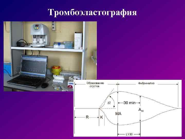 Тромбоэластография 